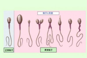 奇形精子